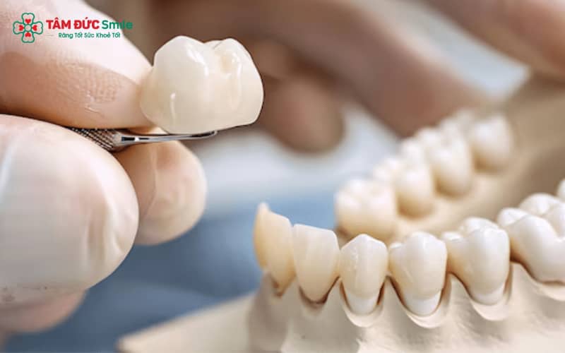 Giải pháp bọc răng sứ giúp hàm răng trở nên thẩm mỹ hơn và cải thiện những khuyết điểm