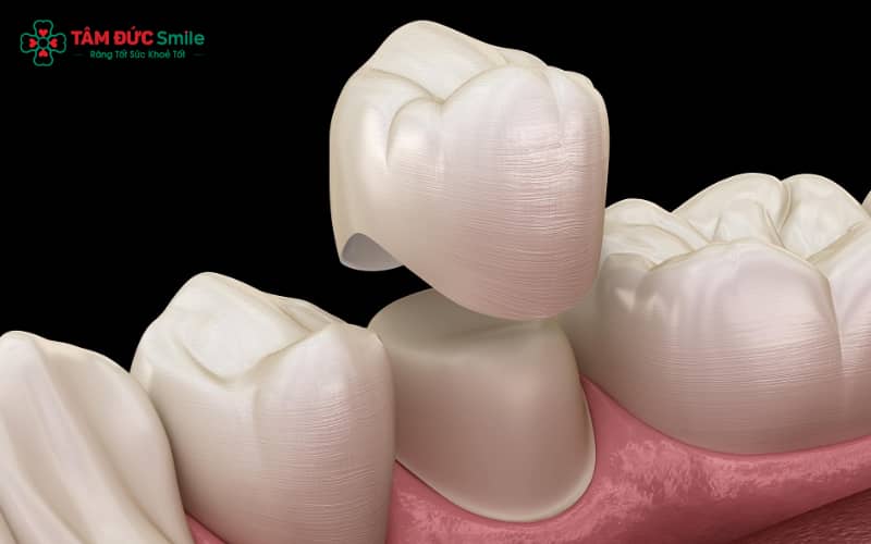 Răng sứ được tạo ra từ khối sứ nguyên chất và thiết kế chính xác nhờ công nghệ CAD/CAM