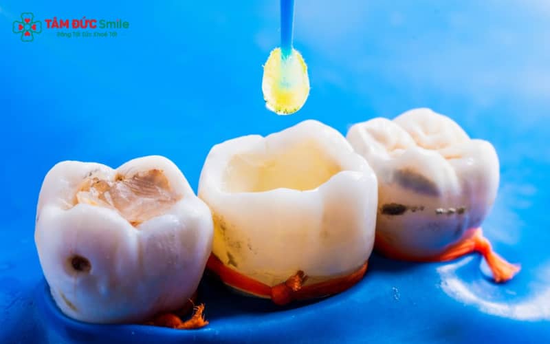 Các phương pháp nha khoa chuyên sâu mang lại hiệu quả trong việc xử lý triệt để nguồn gốc cơn đau