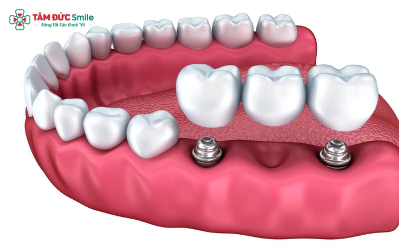 Cầu răng sứ cố định trên Implant là lựa chọn lý tưởng khi cần thay thế nhiều răng bị mất liên tiếp