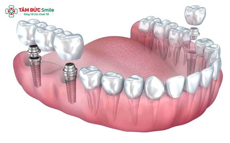 Phương pháp Implant kết hợp cầu răng sứ đảm bảo khả năng ăn nhai ổn định cùng hiệu quả thẩm mỹ cao