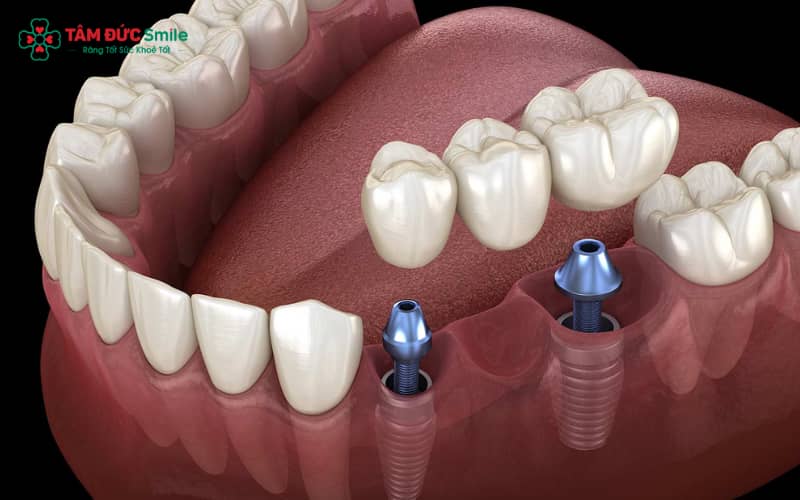 Cầu răng cố định trên Implant là lựa chọn hiện đại, tái tạo cả thân răng và chân răng