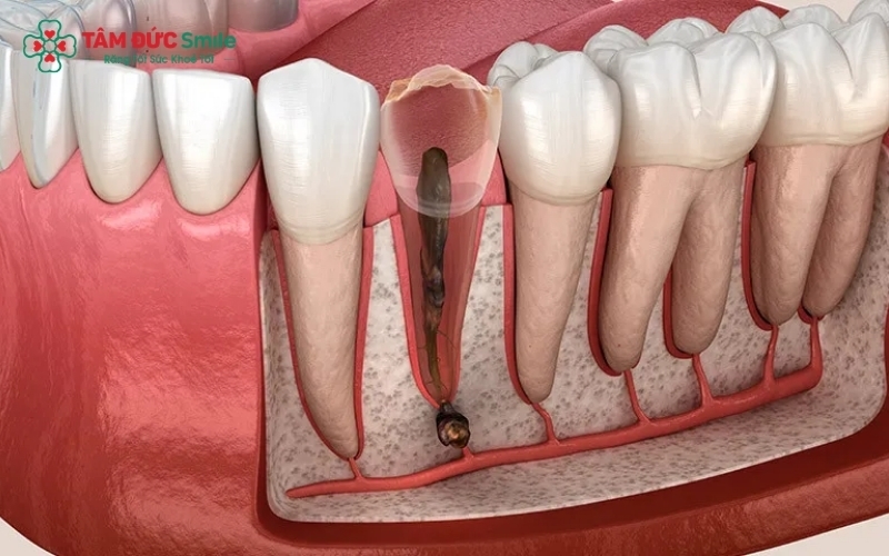 Các dấu hiệu như ê buốt chân răng, sưng nướu là cảnh báo cần thăm khám nha khoa sớm