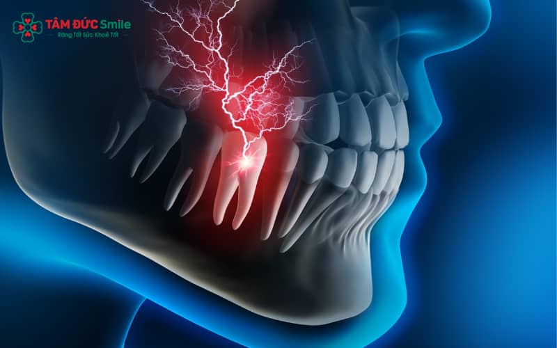 Đau chân răng có thể xảy ra ở nhiều người, chủ yếu bắt nguồn từ sâu răng, viêm nướu, mọc răng khôn, chấn thương hay viêm xoang