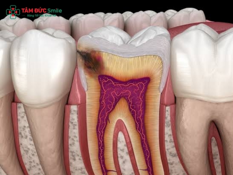 Dấu hiệu sâu răng thường gặp và cách điều trị hiệu quả