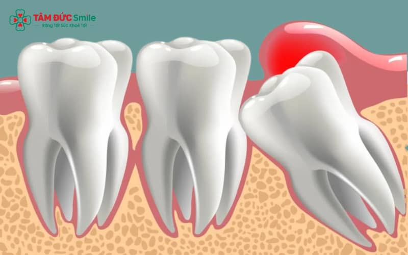 Áp lực từ răng khôn lên xương hàm thường dẫn đến đau nhức liên tục