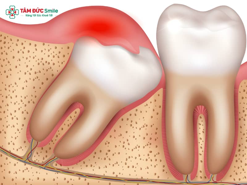Răng khôn thường mọc ở độ tuổi 18–25, dễ gây đau nhức, sưng nướu, hôi miệng, khó há miệng do mọc lệch, mọc ngầm, viêm lợi trùm hoặc tạo áp lực lên xương hàm. Nếu không xử lý kịp thời, có thể dẫn đến nhiễm trùng, sâu răng số 7, u nang xương hàm. Khi gặp triệu chứng, bạn có thể giảm đau tại nhà bằng thuốc giảm đau, kháng viêm, súc miệng nước muối, nhưng cần thăm khám bác sĩ chuyên khoa phẫu thuật răng hàm mặt để được tư vấn. Trong nhiều trường hợp, nha sĩ khuyên nên nhổ răng khôn bằng phương pháp hiện đại như máy siêu âm Piezotome, giúp an toàn, ít đau, thời gian lành thương nhanh khoảng 7–10 ngày. Chi phí nhổ răng khôn dao động 800.000 – 3.000.000 VNĐ/răng, một số trường hợp được bảo hiểm hỗ trợ. 1. Nguyên nhân đau răng khôn thường gặp 1.1. Răng khôn mọc lệch, mọc ngầm gây chèn ép xương hàm Răng khôn là chiếc răng mọc cuối cùng trong cung hàm, thường xuất hiện ở độ tuổi 18 – 25 tuổi. Ở giai đoạn này, xương hàm đã phát triển ổn định, khoảng trống để răng khôn mọc thường rất hẹp. Khi răng khôn mọc lệch hoặc răng khôn mọc ngầm, chiếc răng này không thể trồi lên bình thường mà sẽ: Chèn ép vào xương hàm gây đau nhức răng khôn kéo dài. Tác động lên răng số 7 làm lung lay hoặc tăng nguy cơ sâu răng số 7. Gây ra áp lực liên tục khiến người bệnh khó há miệng, đau khi nhai, đôi khi lan lên thái dương gây đau đầu do răng khôn. Bác sĩ chuyên khoa phẫu thuật răng hàm mặt thường khuyến cáo rằng trong các trường hợp răng khôn mọc lệch, mọc ngầm, giải pháp tối ưu là nhổ răng khôn càng sớm càng tốt. Điều này không chỉ giúp giảm đau nhức mà còn phòng ngừa các biến chứng răng khôn nguy hiểm như u nang, tiêu xương, viêm tủy. 1.2. Viêm lợi trùm và nhiễm trùng nướu Một nguyên nhân phổ biến khác gây đau nhức răng khôn là tình trạng viêm lợi trùm. Khi răng khôn chỉ mọc lên được một phần, phần còn lại bị nướu che phủ. Điều này tạo ra một khe hở nhỏ – nơi dễ dàng kẹt thức ăn và vi khuẩn. Nếu vệ sinh răng miệng không tốt, hậu quả là: Nhiễm trùng nướu quanh răng khôn, gây sưng lợi, đau buốt dữ dội. Có thể kèm theo sốt mọc răng khôn, mệt mỏi, khó ăn nhai. Ở giai đoạn nặng, viêm có thể lan rộng, gây áp xe răng hoặc nhiễm trùng mô mềm vùng má. Điều trị ban đầu thường là dùng thuốc giảm đau, kháng sinh, kháng viêm để kiểm soát nhiễm trùng. Tuy nhiên, nếu tình trạng viêm lợi trùm răng khôn tái đi tái lại nhiều lần, bác sĩ nha khoa sẽ chỉ định nhổ răng khôn để chấm dứt nguồn bệnh. Thời gian lành thương sau nhổ răng khôn thường dao động 7 – 10 ngày, với sự hỗ trợ của công nghệ hiện đại như máy siêu âm Piezotome, quá trình phẫu thuật diễn ra an toàn, ít chảy máu, hạn chế đau và sưng nề. 1.3. Răng khôn gây sâu răng số 7 và hôi miệng Do nằm ở vị trí trong cùng của cung hàm, việc vệ sinh răng khôn thường khó khăn. Thức ăn dễ kẹt lại, bàn chải khó tiếp cận, tạo điều kiện cho mảng bám và vi khuẩn phát triển. Đây là lý do khiến: Răng số 7 (răng hàm lớn quan trọng trong việc ăn nhai) dễ bị sâu răng số 7 khi tiếp giáp với răng khôn mọc lệch. Người bệnh thường bị hôi miệng do vi khuẩn phân hủy thức ăn thừa quanh vùng răng khôn. Lâu dần có thể dẫn đến viêm tủy răng số 7, thậm chí mất răng nếu không điều trị kịp thời. Để ngăn ngừa, bác sĩ thường khuyến nghị: Vệ sinh kỹ bằng bàn chải lông nhỏ, kết hợp chỉ nha khoa và nước súc miệng sát khuẩn. Tái khám nha khoa định kỳ để phát hiện sớm tình trạng sâu răng. Cân nhắc nhổ răng khôn nếu vị trí mọc gây ảnh hưởng đến răng số 7 và sức khỏe toàn hàm. Chi phí nhổ răng khôn trong các trường hợp này dao động khoảng 800.000 – 3.000.000 VNĐ/răng, tùy theo mức độ khó và công nghệ áp dụng. Một số trường hợp có thể được bảo hiểm y tế hỗ trợ một phần chi phí nếu nhổ tại bệnh viện răng hàm mặt. 2. Cần làm gì khi bị đau răng khôn? Đau răng khôn là trải nghiệm rất phổ biến, đặc biệt ở độ tuổi 18–25 tuổi khi răng bắt đầu mọc. Cơn đau thường xuất phát từ nhiều nguyên nhân như răng khôn mọc lệch, răng khôn mọc ngầm, viêm lợi trùm, hay sự chèn ép giữa xương hàm và răng bên cạnh. Nếu không xử lý kịp thời, người bệnh có thể gặp biến chứng răng khôn như sâu răng số 7, nhiễm trùng, hay thậm chí hình thành u nang xương hàm. Vậy khi bị đau răng khôn, chúng ta cần làm gì để giảm đau, chăm sóc đúng cách và bảo vệ sức khỏe răng miệng? 2.1. Cách xử lý tạm thời tại nhà Trong nhiều trường hợp, cơn đau nhức răng khôn chỉ xuất hiện thoáng qua vài ngày, sau đó dịu dần. Tuy nhiên, nếu không được xử lý đúng cách, tình trạng này có thể kéo dài. Một số biện pháp tạm thời tại nhà giúp giảm triệu chứng hiệu quả: 2.1.1. Giảm đau nhanh chóng Chườm lạnh: Dùng túi đá bọc trong khăn sạch, áp lên vùng má ngoài nơi có sưng nướu từ 10–15 phút, giúp giảm viêm và tê cứng vùng đau. Nước muối sinh lý: Súc miệng với dung dịch nước muối ấm pha loãng nhiều lần trong ngày giúp diệt khuẩn, giảm viêm viêm lợi trùm răng khôn. Thuốc giảm đau không kê đơn: Các loại thuốc như Paracetamol, Ibuprofen có thể giúp kiểm soát cơn đau. Tuy nhiên, cần uống theo chỉ dẫn, không lạm dụng. 2.1.2. Vệ sinh răng miệng đúng cách Đánh răng nhẹ nhàng bằng bàn chải lông mềm, tránh tác động mạnh lên vùng lợi sưng đau. Dùng chỉ nha khoa loại mảnh để loại bỏ thức ăn kẹt ở vùng răng khôn mọc lệch – nguyên nhân gây hôi miệng và viêm. Hạn chế dùng nước súc miệng chứa cồn vì có thể làm niêm mạc nướu bị kích ứng. 2.1.3. Chế độ ăn uống hỗ trợ Ăn thức ăn mềm, loãng như cháo, súp, sinh tố để tránh tác động lực nhai lên răng. Tránh thực phẩm cay nóng, quá cứng, hoặc chứa nhiều đường – dễ gây sâu răng. Uống đủ nước, bổ sung vitamin C để tăng cường sức đề kháng, hỗ trợ hồi phục mô nướu. 2.2. Khi nào cần đi nha sĩ ngay? Dù các biện pháp tại nhà có thể giúp tạm thời giảm triệu chứng, nhưng có những dấu hiệu báo động cần phải đi khám bác sĩ chuyên khoa phẫu thuật răng hàm mặt ngay lập tức: Sưng nướu lan rộng kèm mủ, sốt cao → có nguy cơ nhiễm trùng. Khó há miệng hoặc đau lan sang vùng thái dương, đau đầu do răng khôn. Răng khôn mọc lệch, mọc ngầm đâm vào răng số 7 gây tổn thương men răng hoặc sâu răng số 7. Cơn đau kéo dài liên tục trên 7–10 ngày không thuyên giảm dù đã dùng thuốc. Trong các trường hợp này, bác sĩ sẽ thăm khám bằng phim X-quang, đánh giá tình trạng xương hàm, xác định mức độ biến chứng răng khôn để đưa ra hướng điều trị. 2.3. Thuốc giảm đau và phương pháp điều trị không xâm lấn Nếu tình trạng đau chưa nghiêm trọng hoặc chưa cần can thiệp nhổ, bác sĩ có thể chỉ định: 2.3.1. Thuốc hỗ trợ Thuốc giảm đau: Paracetamol, Ibuprofen, Diclofenac giúp giảm đau nhanh. Thuốc kháng viêm: Prednisolone hoặc thuốc kháng viêm không steroid (NSAID) hạn chế sưng đỏ vùng lợi. Thuốc kháng sinh: Amoxicillin, Metronidazole được kê khi có dấu hiệu nhiễm trùng. Lưu ý: Tuyệt đối không tự ý dùng thuốc kháng sinh mà không có chỉ định của bác sĩ để tránh tình trạng kháng kháng sinh. 2.3.2. Điều trị nha khoa hỗ trợ Cắt lợi trùm: Trường hợp viêm lợi trùm răng khôn tái phát, bác sĩ có thể tiến hành cắt bỏ phần lợi phủ để giải phóng răng. Làm sạch vùng quanh răng khôn: Sử dụng dụng cụ chuyên dụng để loại bỏ mảng bám và thức ăn kẹt. Theo dõi định kỳ: Với răng khôn mọc thẳng nhưng gây đau do chưa nhú hoàn toàn, bác sĩ thường hẹn tái khám định kỳ để theo dõi tiến trình mọc. 3. Có nên nhổ răng khôn không? 3.1. Trường hợp cần nhổ răng khôn gấp (mọc lệch, mọc ngầm, biến chứng) Răng khôn là chiếc răng cuối cùng mọc lên trong cung hàm, thường xuất hiện trong độ tuổi 18 – 25 tuổi. Không giống như những răng khác, răng khôn thường mọc khi xương hàm đã phát triển hoàn thiện, khoảng trống không còn nhiều. Điều này dẫn đến tình trạng răng khôn mọc lệch, răng khôn mọc ngầm, gây ra nhiều biến chứng nguy hiểm. Răng khôn mọc lệch: Khi răng khôn không đủ chỗ để mọc thẳng đứng, nó sẽ nghiêng về phía trước, phía sau hoặc ra má. Hậu quả là gây chèn ép xương hàm, làm tổn thương răng số 7, khiến bệnh nhân bị sâu răng số 7, dễ viêm nhiễm và đau nhức. Răng khôn mọc ngầm: Trong nhiều trường hợp, răng khôn bị kẹt hoàn toàn trong nướu hoặc xương hàm, gọi là mọc ngầm. Điều này gây đau nhức dữ dội, sưng nướu, thậm chí tạo thành u nang xương hàm. Viêm lợi trùm răng khôn: Khi răng khôn mọc một phần, phần nướu phía trên bị lợi trùm. Khu vực này rất dễ bị kẹt thức ăn, gây viêm lợi trùm, sưng đỏ, đau nhức, sốt, hôi miệng. Biến chứng toàn thân: Nếu nhiễm trùng từ răng khôn lan rộng, bệnh nhân có thể gặp các biến chứng nguy hiểm như viêm tủy răng, áp xe, viêm xương hàm, thậm chí ảnh hưởng đến sức khỏe toàn thân. Trong những trường hợp này, bác sĩ chuyên khoa phẫu thuật răng hàm mặt luôn khuyến cáo bệnh nhân nhổ răng khôn gấp để tránh biến chứng kéo dài, gây tổn thương các răng bên cạnh và sức khỏe răng miệng nói chung. 3.2. Lợi ích của việc nhổ răng khôn sớm Nhiều người thường chần chừ khi nghĩ đến việc nhổ răng khôn, một phần do sợ đau, một phần do lo ngại chi phí. Tuy nhiên, các nghiên cứu nha khoa đã chứng minh rằng nhổ răng khôn sớm mang lại rất nhiều lợi ích: Ngăn ngừa biến chứng: Khi loại bỏ sớm răng khôn mọc lệch hoặc mọc ngầm, bạn sẽ tránh được tình trạng sâu răng số 7, viêm lợi trùm, và nguy cơ u nang xương hàm. Giảm đau và khó chịu: Việc nhổ sớm giúp chấm dứt nhanh tình trạng đau nhức răng khôn, sưng nướu, đau đầu, khó há miệng. Hạn chế ảnh hưởng đến chỉnh nha: Với những ai đang hoặc sắp niềng răng, việc loại bỏ răng khôn sẽ ngăn chặn nguy cơ làm xô lệch răng sau khi chỉnh nha. Phục hồi nhanh hơn: Thời gian lành thương khi nhổ răng khôn ở độ tuổi trẻ (18 – 25) chỉ khoảng 7 – 10 ngày, nhanh và ít biến chứng hơn so với khi đã lớn tuổi. Chi phí hợp lý hơn: So với việc điều trị các biến chứng nghiêm trọng, chi phí nhổ răng khôn sớm (trung bình 800.000 – 3.000.000 VNĐ/răng) thấp hơn nhiều so với việc chữa u nang, sâu răng số 7 hay viêm xương hàm. Có thể thấy, nhổ răng khôn sớm không chỉ giúp bảo vệ sức khỏe răng miệng mà còn tiết kiệm thời gian và tiền bạc trong tương lai