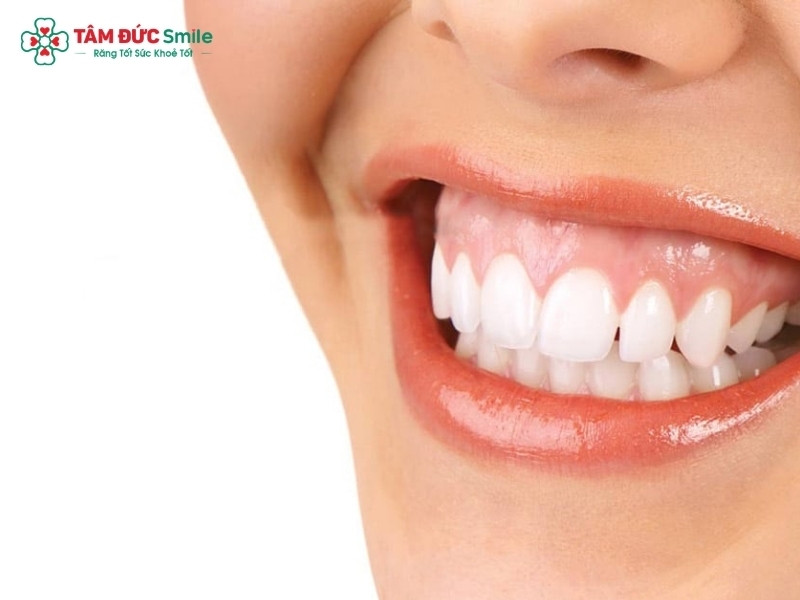 Cười hở lợi có chữa được không? Các phương pháp điều trị cười hở lợi hiện nay