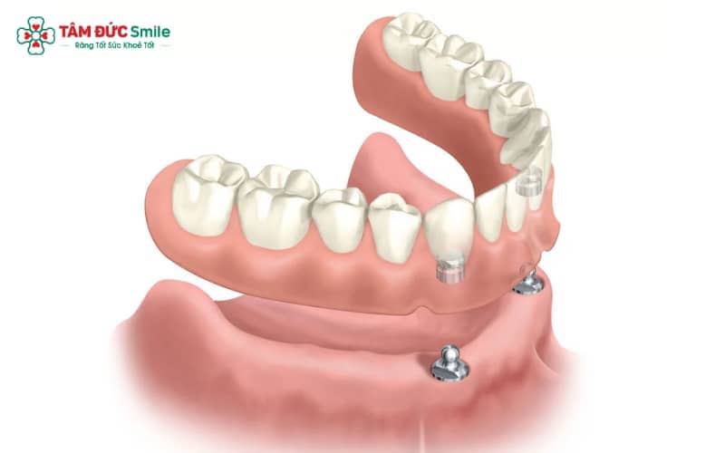Hàm tháo lắp trên Implant là lựa chọn tối ưu, đáp ứng đồng thời nhu cầu tiện lợi, thẩm mỹ và hiệu quả ăn nhai