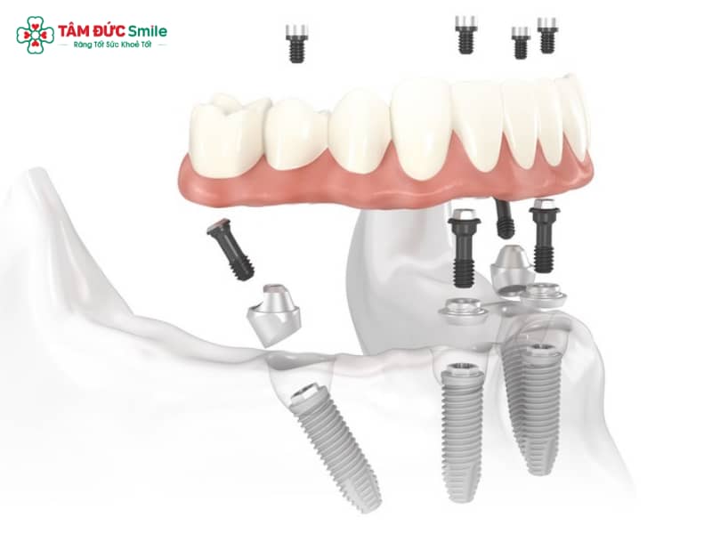 Implant Multi: Cấu tạo, ưu điểm và quy trình cấy ghép toàn hàm