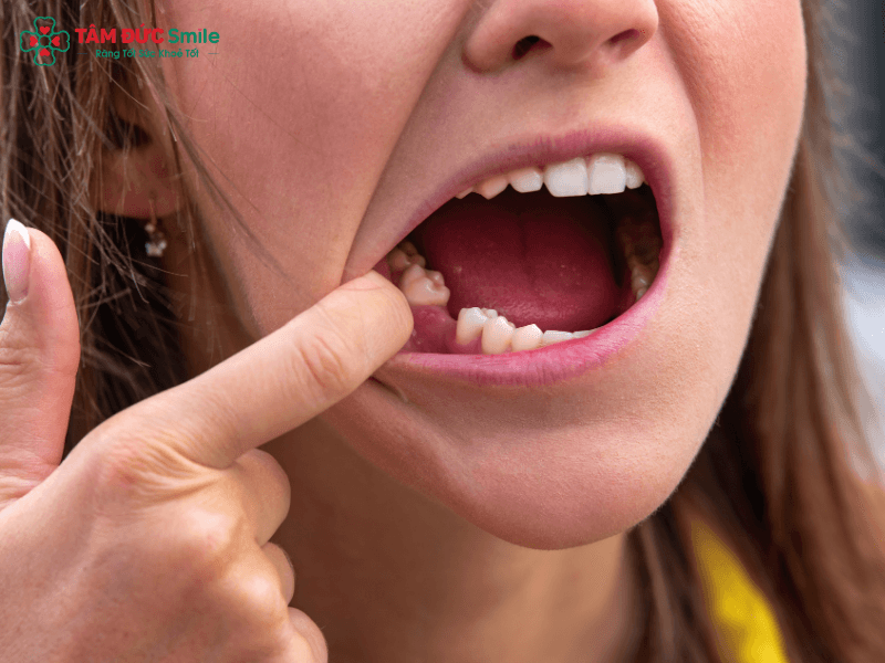 Răng số 6 - Răng hàm lớn thứ nhất đóng vai trò chủ chốt trong việc ăn nhai.