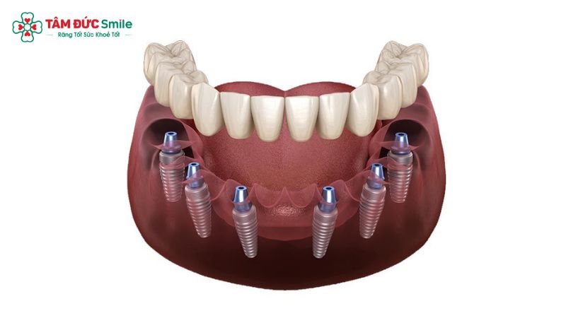 may-cam-implant-11