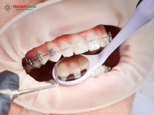 Niềng răng thẩm mỹ là một phương pháp chỉnh nha được sử dụng phổ biến nhằm sắp xếp răng đều đặn