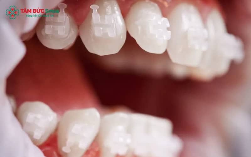 Niềng răng mắc cài pha lê mang lại nụ cười tự tin nhờ mắc cài trong suốt và dây cung màu trắng tinh tế