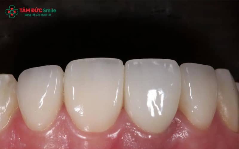 Răng cửa là chiếc răng nằm ở phía trước cung hàm, đóng vai trò vô cùng quan trọng trong việc ăn nhai, phát âm