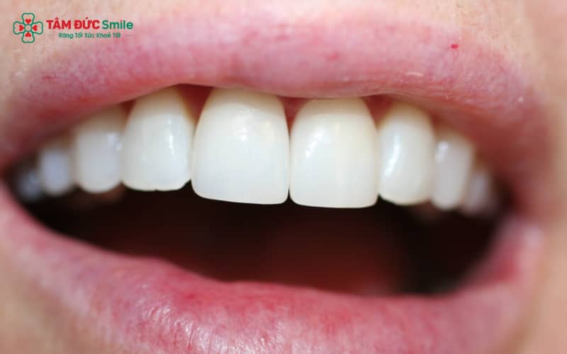Răng cửa sữa là những chiếc răng đầu tiên xuất hiện trong miệng trẻ