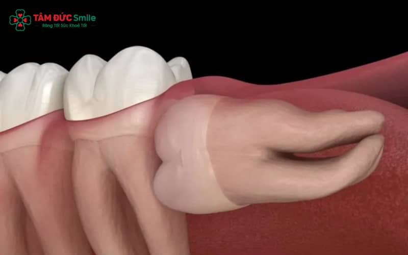Răng khôn mọc ngang thường ẩn dưới xương hàm, tác động lên răng bên cạnh và chỉ hiển thị trên phim X-quang