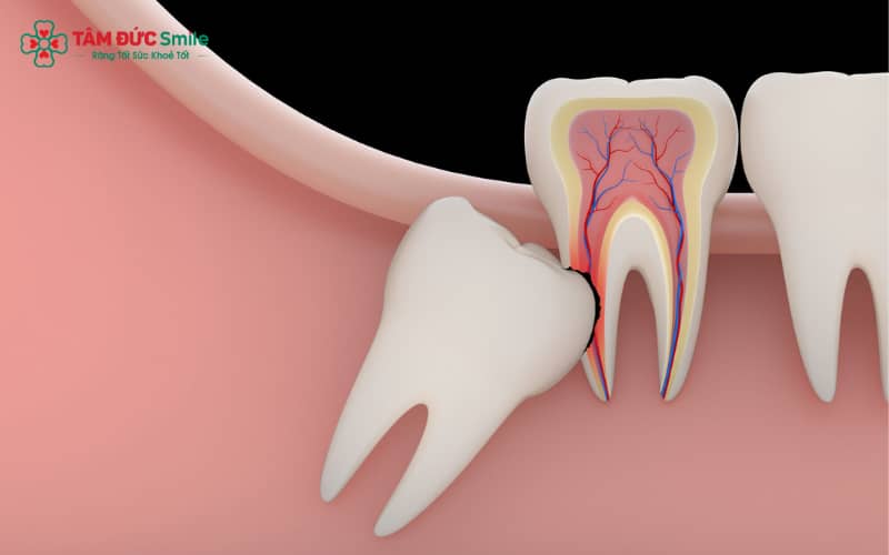 Răng khôn mọc ngang là nguyên nhân phổ biến gây sưng nướu, viêm nhiễm, sâu răng và u nang răng