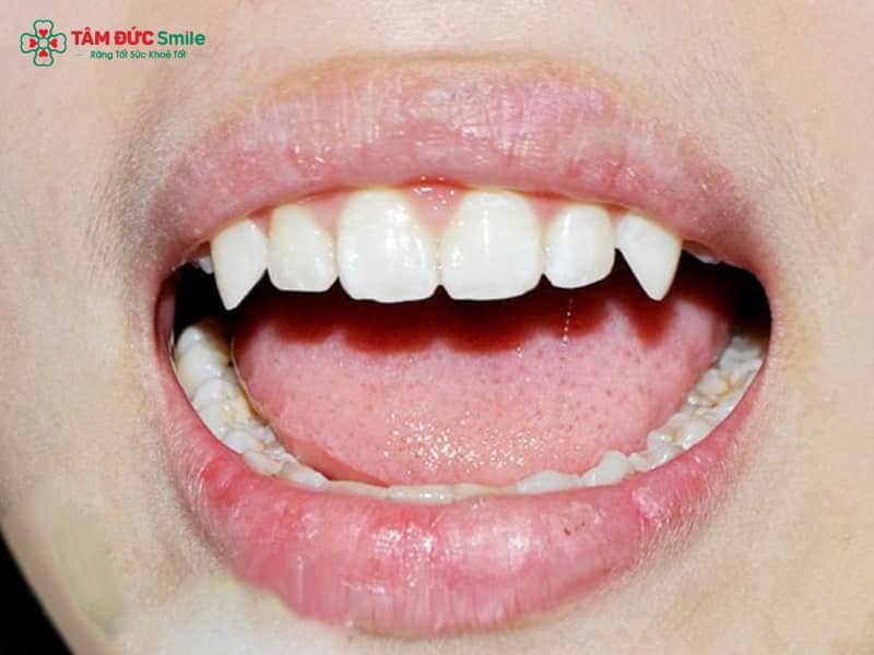 Răng nanh là chiếc răng đặc biệt trong hệ răng người, nằm giữa răng cửa và răng hàm, với hình dáng chóp nhọn, chân răng dài và chắc khỏe.