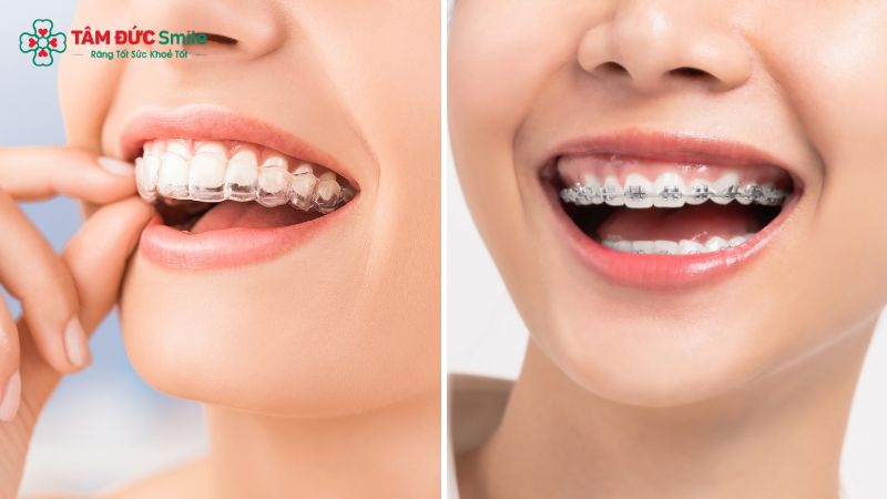 so-sanh-nieng-invisalign-va-mac-cai-1