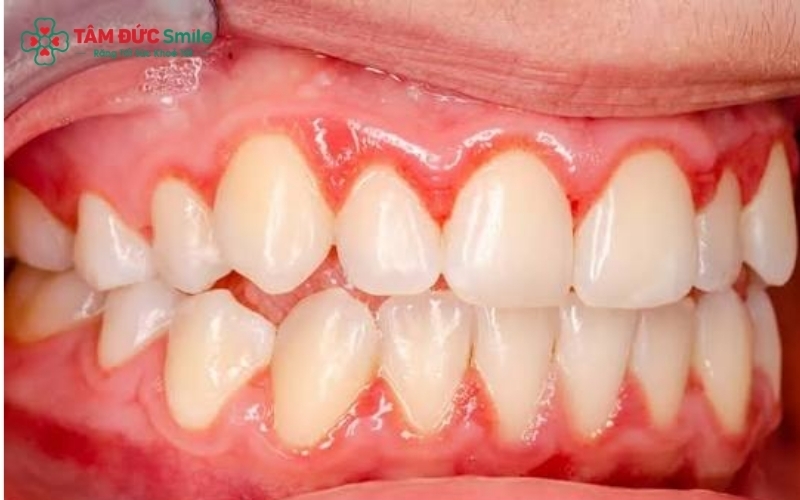 Mảng bám và cao răng là 'thủ phạm' hàng đầu gây kích ứng và sưng nướu.