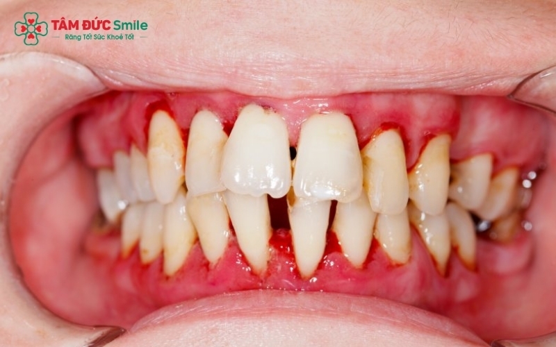 Sưng nướu nếu không điều trị có thể tiến triển thành viêm nha chu và tiêu xương ổ răng.