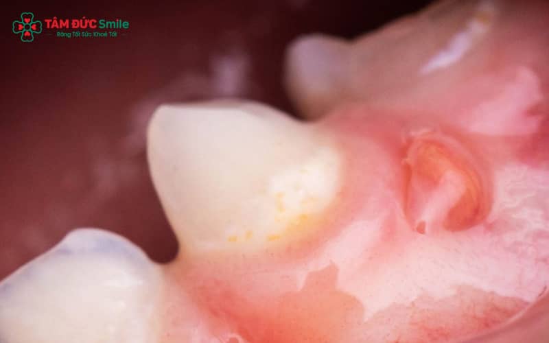 Sưng nướu vùng răng hàm dưới trong cùng thường liên quan đến tình trạng răng khôn mọc lệch, viêm nướu hoặc sâu răng tiến triển