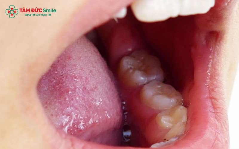 Khi vệ sinh răng miệng không đảm bảo kết hợp với chế độ ăn thiếu cân đối, nướu răng trong cùng hàm dưới dễ bị viêm và sưng