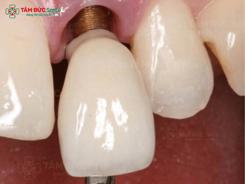 tac-dung-phu-trong-rang-implant-2