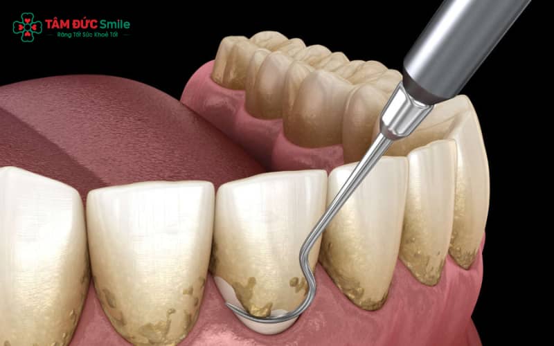 Việc bỏ qua cạo vôi răng định kỳ là nguyên nhân chính gây viêm nướu