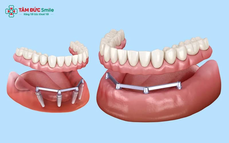 Trong phục hình implant toàn hàm, thanh bar đóng vai trò trung gian gắn kết, giúp hàm răng giả cố định vững chắc