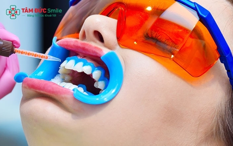 Hướng dẫn sử dụng gel tẩy trắng đúng cách để đạt hiệu quả cao và bảo vệ nướu lợi an toàn.