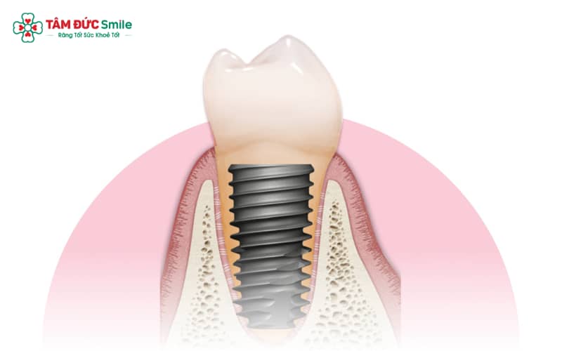 Cấy Implant Hiossen cần được thực hiện bởi bác sĩ có chứng chỉ Implant quốc tế, đảm bảo chuẩn y khoa