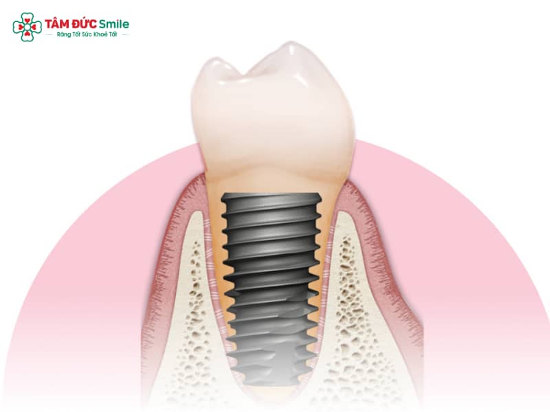Trụ Implant Hiossen Mỹ: Xuất xứ, Ưu điểm và Lưu ý cấy ghép