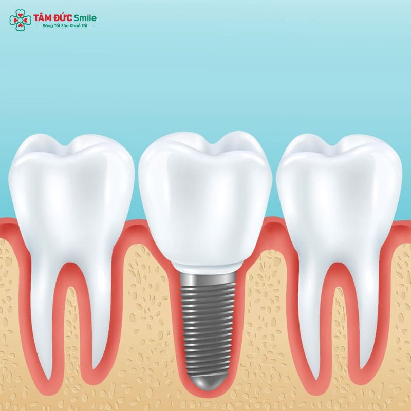 tru-implant-nobel-1