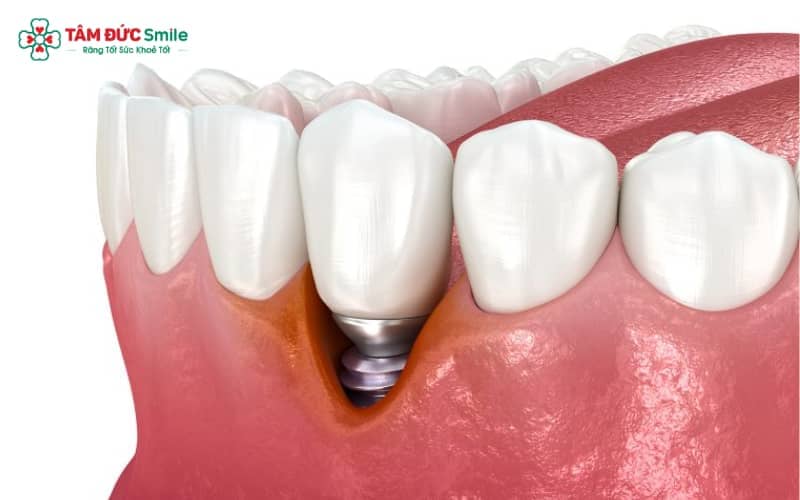 Viêm quanh Implant là tình trạng hay gặp, song có thể gây hậu quả nghiêm trọng nếu để kéo dài