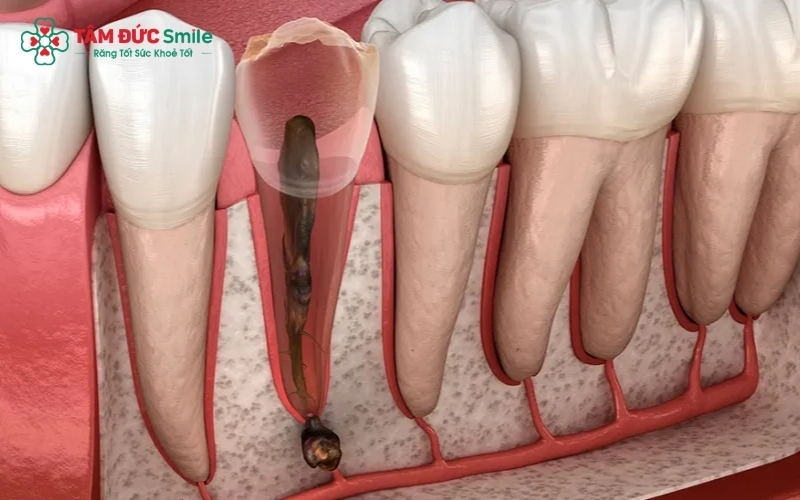 Tủy răng là "trái tim" của răng, chứa hệ thống mạch máu và thần kinh nuôi dưỡng răng.