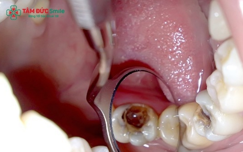 Nhận biết sớm các dấu hiệu viêm tủy từ ê buốt đến đau nhức dữ dội để điều trị kịp thời.