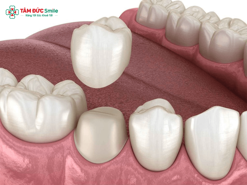 Bọc răng sứ sử dụng mão sứ bao phủ bên ngoài răng thật đã được chuẩn bị nhằm phục hồi hình dáng, màu sắc và chức năng ăn nhai tại Nha khoa Tâm Đức Smile.