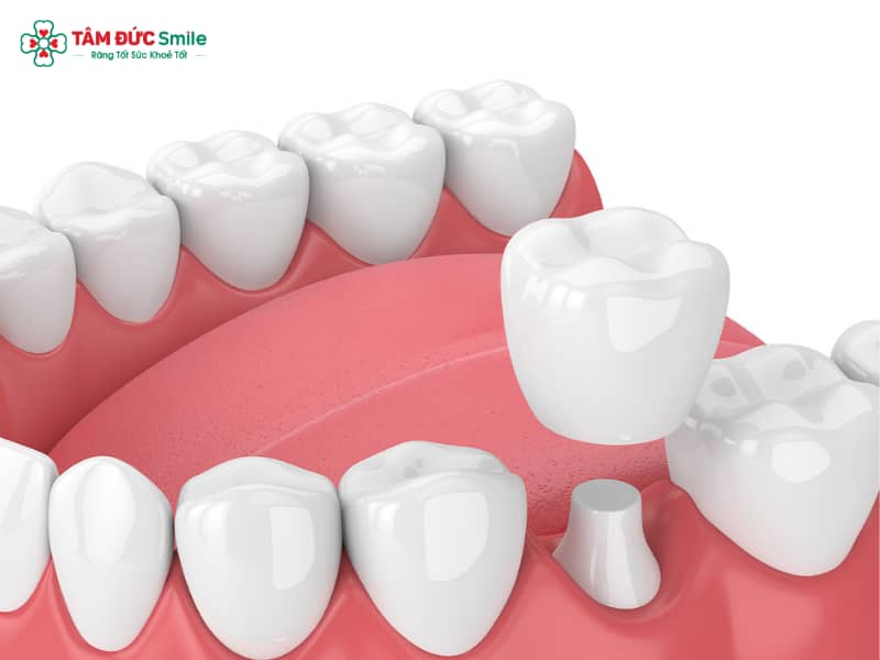 Bọc răng sứ có bền không? Tuổi thọ, độ bền và cách chăm sóc răng sứ lâu dài