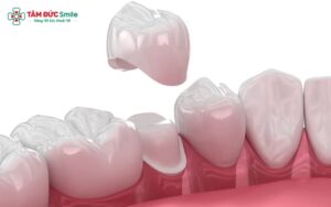 Bọc răng sứ có bị hôi miệng không? Nguyên nhân, cách khắc phục và phòng ngừa