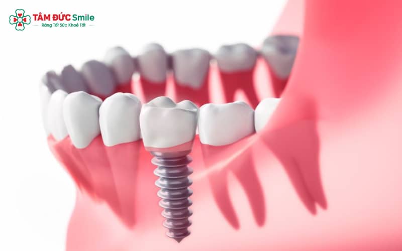 Các thương hiệu Implant nổi tiếng trên thị trường như Hàn Quốc, Mỹ, Thụy Sĩ, Israel, Đức, Pháp