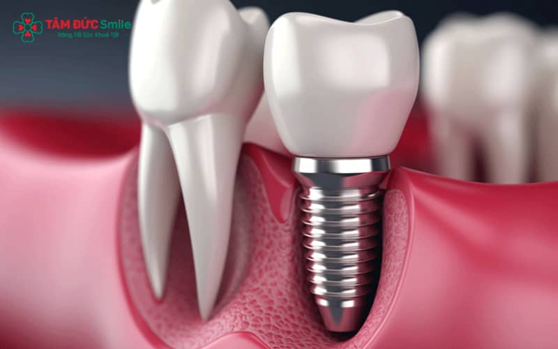 Trụ Implant Thụy Sĩ có độ bền cao, tương thích sinh học tốt và hỗ trợ tích hợp ổn định với xương hàm.