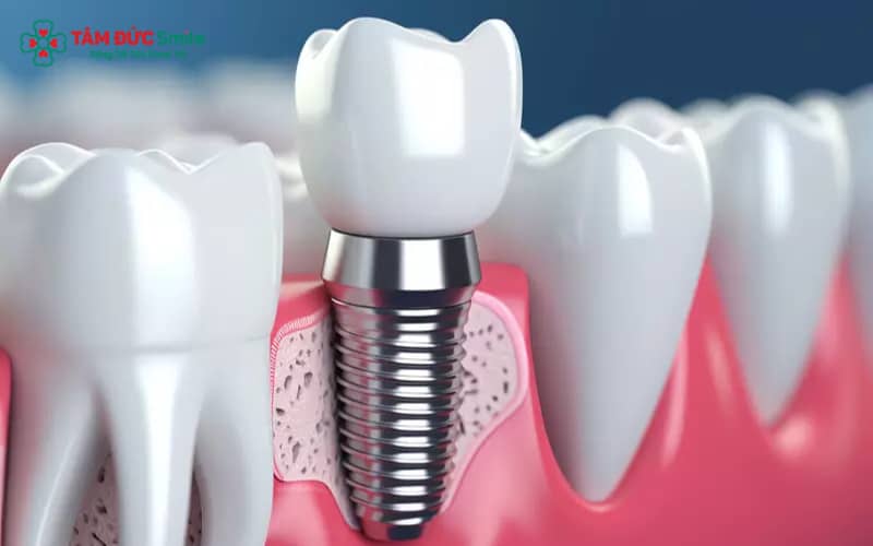 Kích thước trụ cấy được điều chỉnh linh hoạt theo đặc điểm xương hàm và vị trí răng mất.