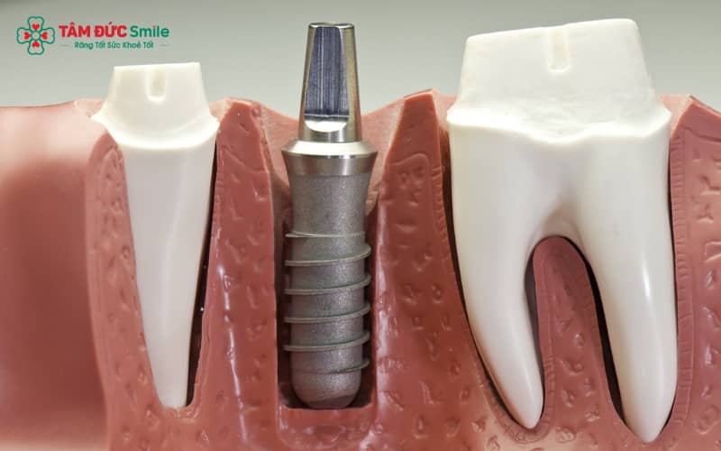 Kích thước trụ implant được điều chỉnh theo từng vị trí răng để đáp ứng yêu cầu về thẩm mỹ và chức năng
