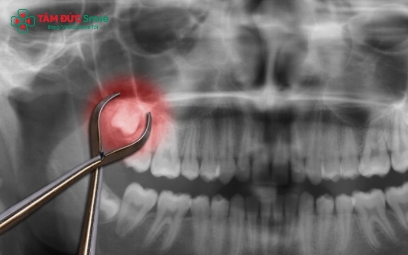 Bác sĩ sẽ chỉ định loại bỏ khi răng gây biến chứng, mọc lệch hoặc đe dọa sức khỏe của răng số 7 kế cận.