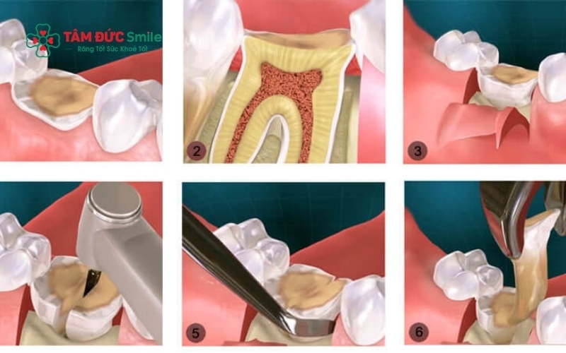 Tại Tâm Đức Smile, việc chụp phim CT 3D giúp bác sĩ đánh giá chính xác vị trí răng so với ống thần kinh, từ đó lập kế hoạch tiểu phẫu an toàn và hạn chế tối đa các biến chứng.
