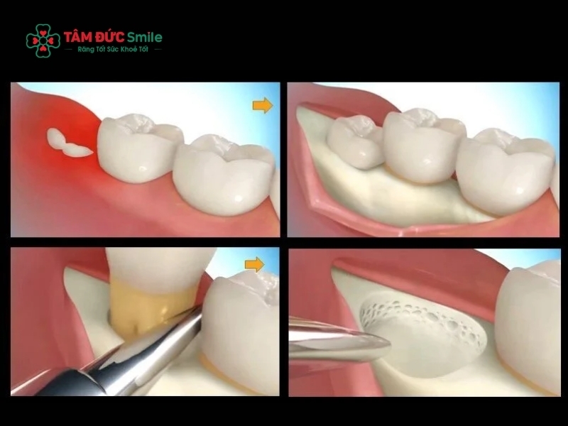 Có nên nhổ răng số 8 không? Quy trình nhổ răng số 8 tại Nha khoa?