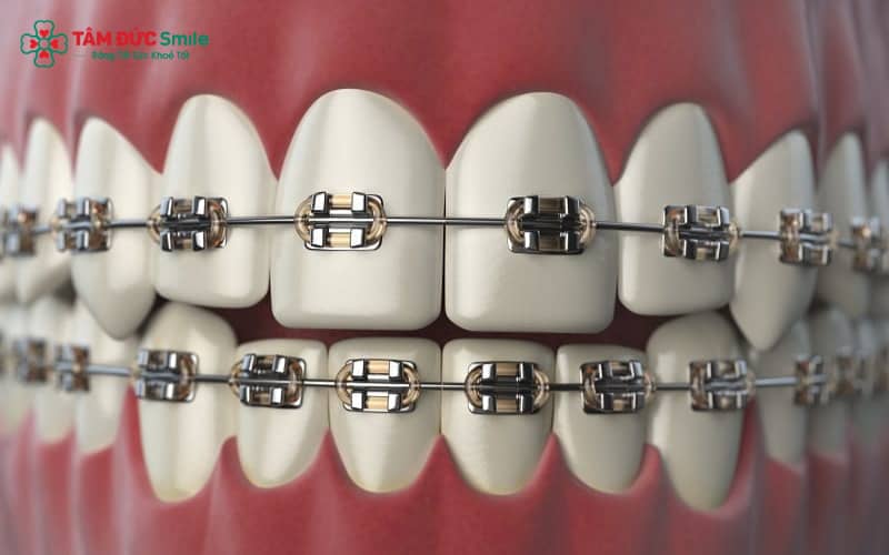 Bạn có thể ăn cơm trở lại sau khoảng 1 tuần kể từ khi niềng răng