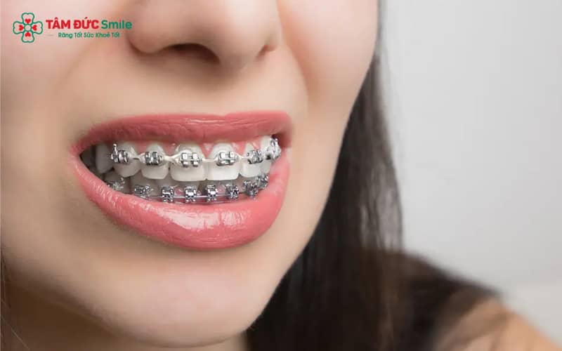 Trong chế độ ăn khi niềng răng, cần tránh: đồ cứng, đồ dai, đồ dính và đồ giòn vụn